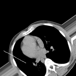 Normal ct scan